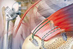 Der Tätigkeitsschwerpunkt unserer chirurgischen Eingriffe ist die Schulter. Wir schaffen Abhilfe, wenn Sie beispielsweise an einer Kalkschulter leiden, oder Verletzungen im Bereich der Rotatorenmanschette haben. Auf dem Bild sehen Sie eine arthroskopische Rotatorenmanschettennaht.